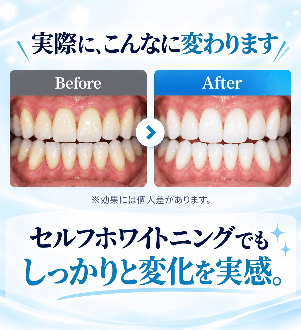 セルフホワイトニング Before After